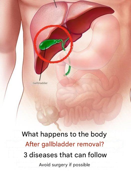 What happens to the body after gallbladder removal? 3 possible complications