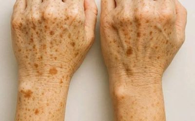 Recent research confirms that these spots appear because… See more”