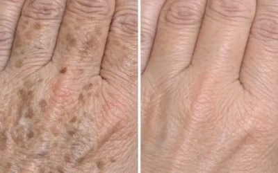My mom taught me this trick to diminish dark age spots on my hands in just 3 mins with 0 effort. Here’s how it works